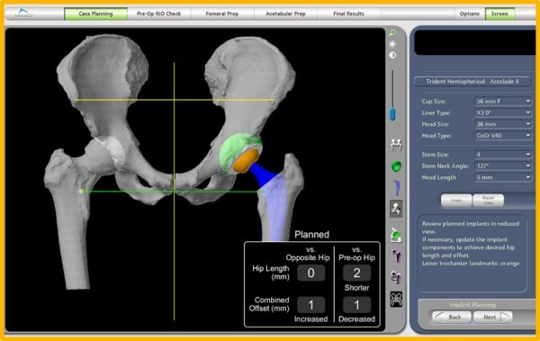 Mako 3D planning software based off a CT scan